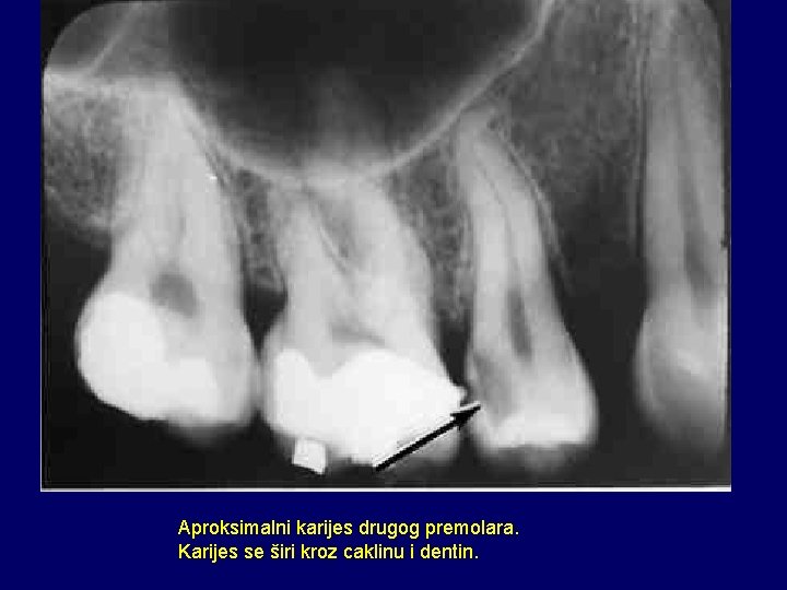 Aproksimalni karijes drugog premolara. Karijes se širi kroz caklinu i dentin. 
