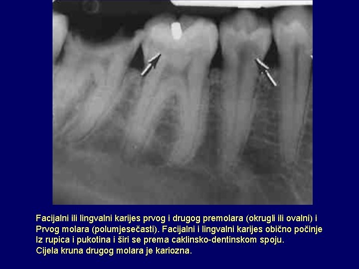 Facijalni ili lingvalni karijes prvog i drugog premolara (okrugli ili ovalni) i Prvog molara