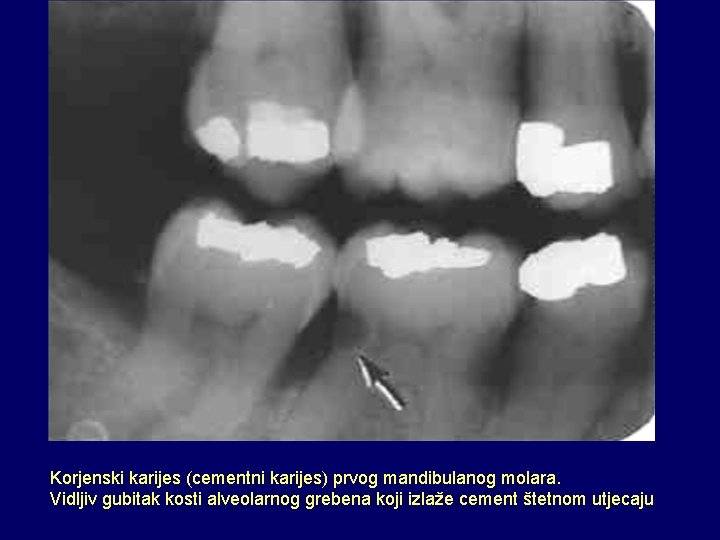 Korjenski karijes (cementni karijes) prvog mandibulanog molara. Vidljiv gubitak kosti alveolarnog grebena koji izlaže