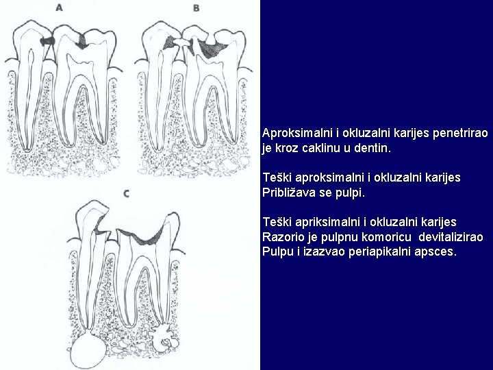 Aproksimalni i okluzalni karijes penetrirao je kroz caklinu u dentin. Teški aproksimalni i okluzalni