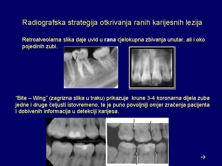 Radiografska strategija otkrivanja ranih karijesnih lezija Retroalveolarna slika daje uvid u rana cjelokupna zbivanja