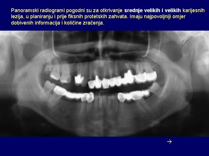 Panoramski radiogrami pogodni su za otkrivanje srednje velikih i velikih karijesnih lezija, u planiranju