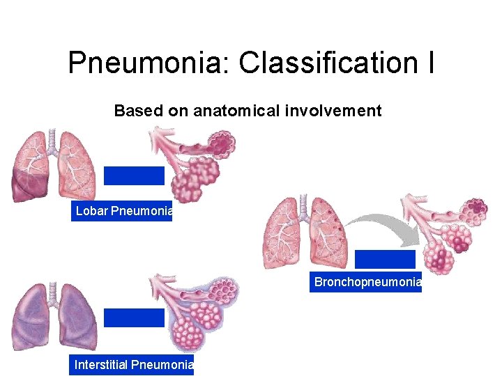 Pneumonia: Classification I Based on anatomical involvement Lobar Pneumonia Bronchopneumonia Interstitial Pneumonia 