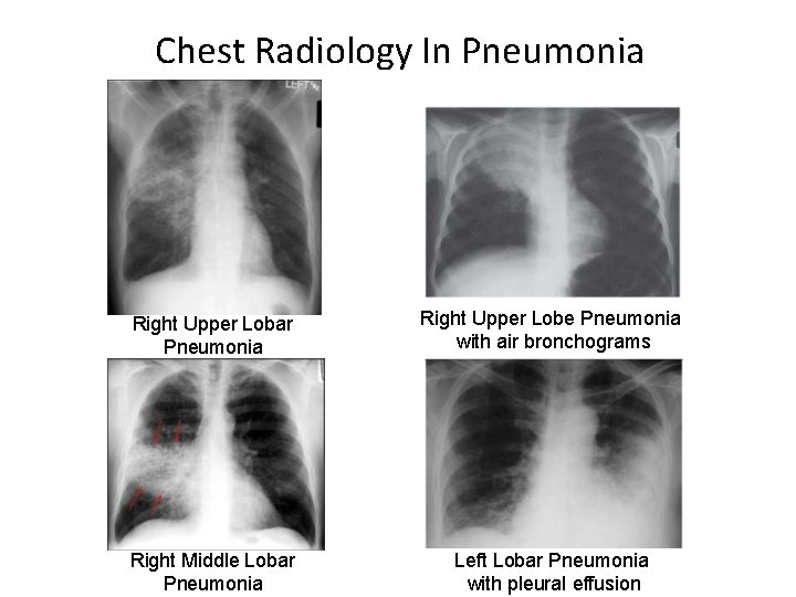 Chest Radiology In Pneumonia Right Upper Lobar Pneumonia Right Upper Lobe Pneumonia with air