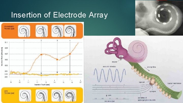 Insertion of Electrode Array 