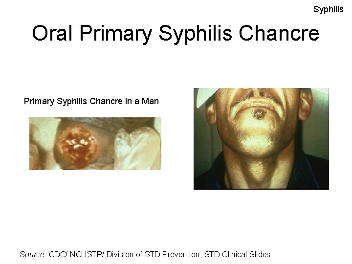 Syphilis Oral Primary Syphilis Chancre in a Man Source: CDC/ NCHSTP/ Division of STD