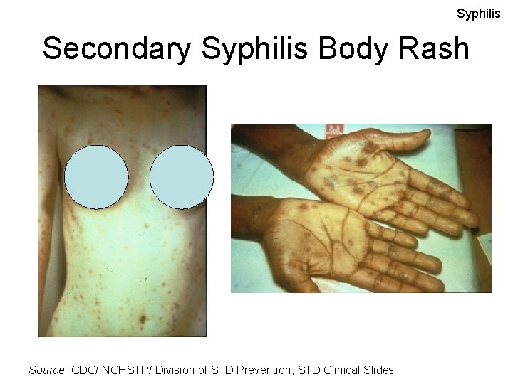 Syphilis Secondary Syphilis Body Rash Source: CDC/ NCHSTP/ Division of STD Prevention, STD Clinical