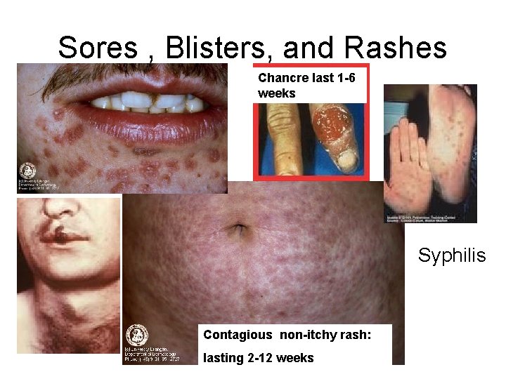 Sores , Blisters, and Rashes Chancre last 1 -6 weeks Syphilis Contagious non-itchy rash: