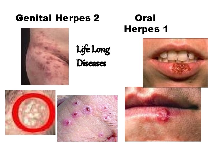 Genital Herpes 2 Life Long Diseases Oral Herpes 1 