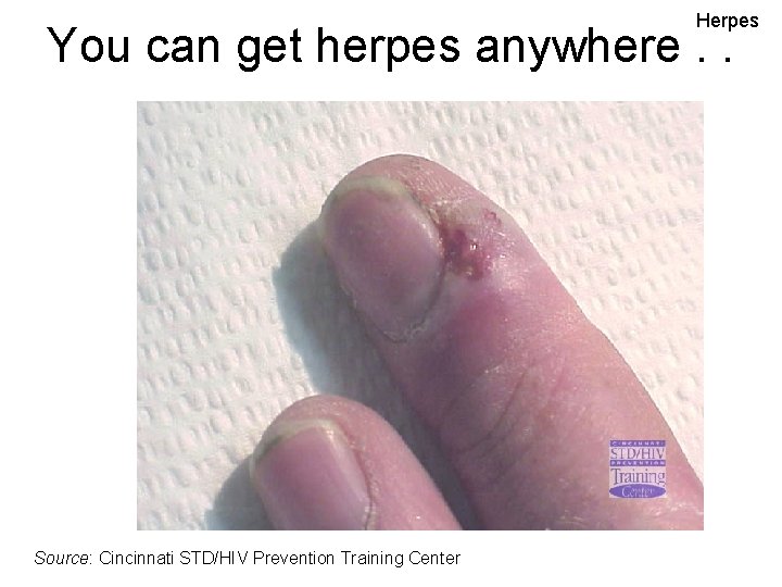 Herpes You can get herpes anywhere. . . Source: Cincinnati STD/HIV Prevention Training Center