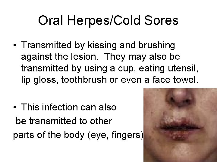 Oral Herpes/Cold Sores • Transmitted by kissing and brushing against the lesion. They may