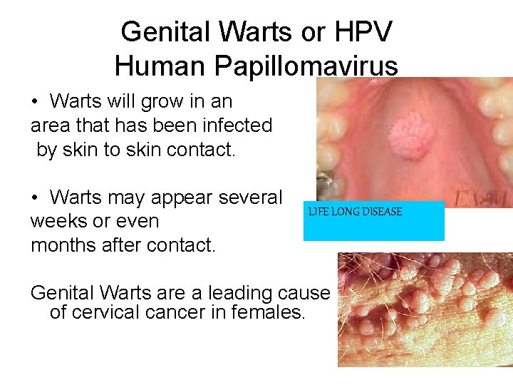 Genital Warts or HPV Human Papillomavirus • Warts will grow in an area that