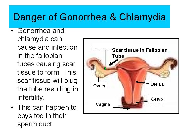 Danger of Gonorrhea & Chlamydia • Gonorrhea and chlamydia can cause and infection in