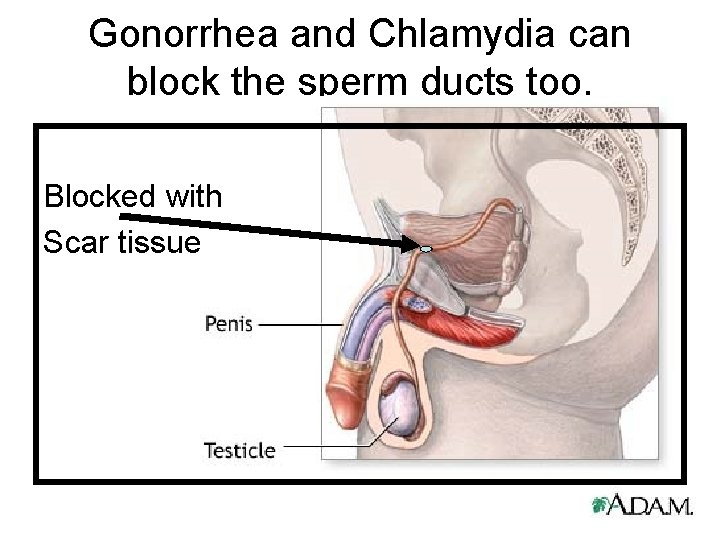Gonorrhea and Chlamydia can block the sperm ducts too. Blocked with Scar tissue 
