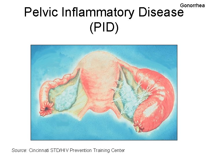 Gonorrhea Pelvic Inflammatory Disease (PID) Source: Cincinnati STD/HIV Prevention Training Center 
