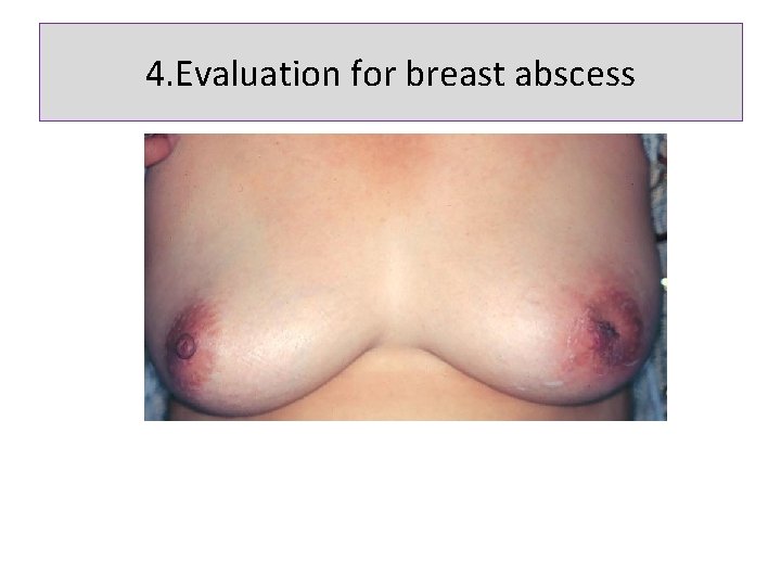 4. Evaluation for breast abscess 