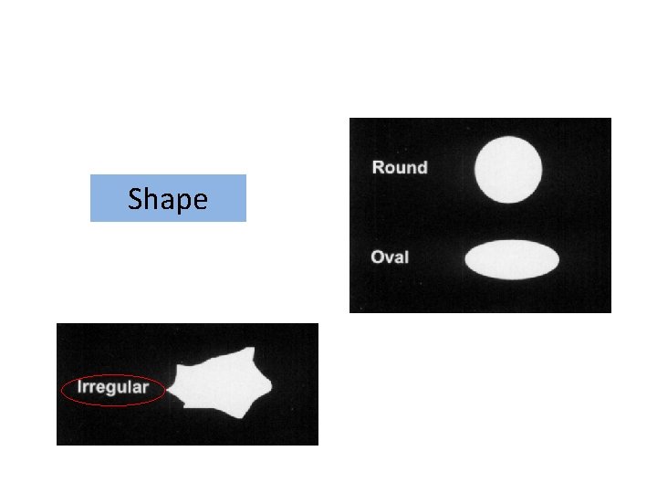 Breast mass Shape 