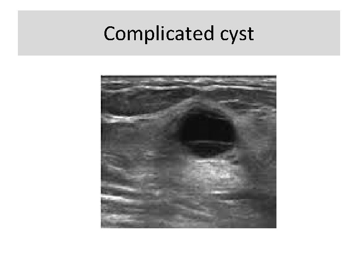 Complicated cyst 