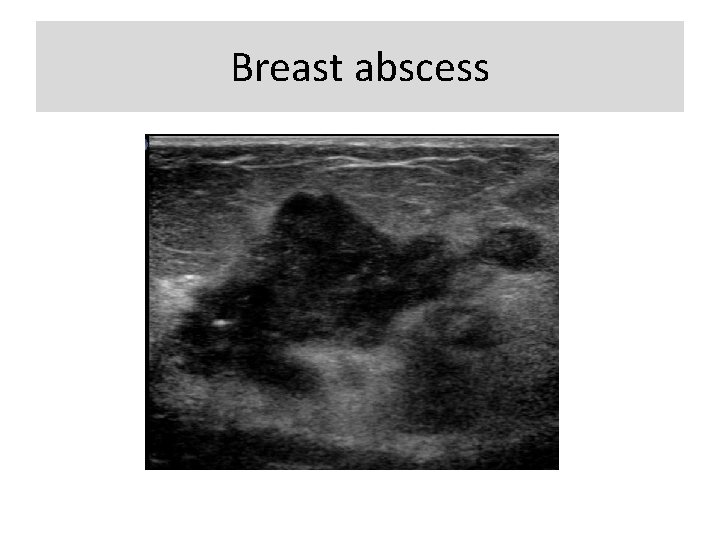 Breast abscess 