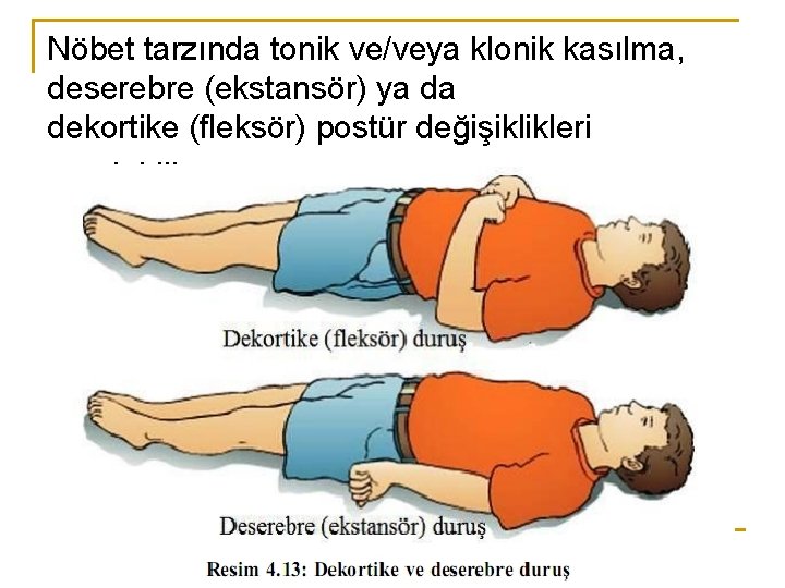 Nöbet tarzında tonik ve/veya klonik kasılma, deserebre (ekstansör) ya da dekortike (fleksör) postür değişiklikleri