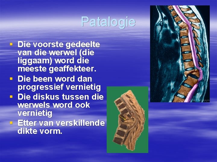 Patalogie § Die voorste gedeelte van die werwel (die liggaam) word die meeste geaffekteer.