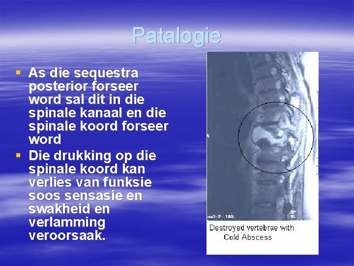 Patalogie § As die sequestra posterior forseer word sal dit in die spinale kanaal