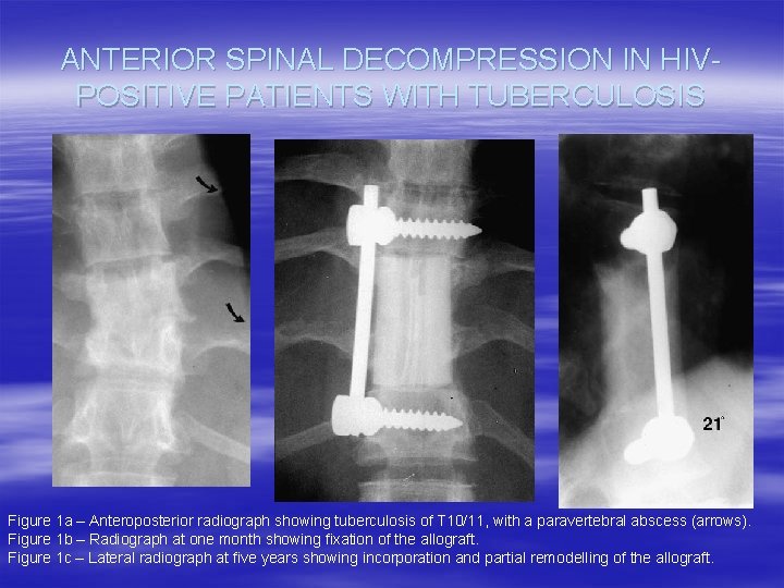 ANTERIOR SPINAL DECOMPRESSION IN HIVPOSITIVE PATIENTS WITH TUBERCULOSIS Figure 1 a – Anteroposterior radiograph