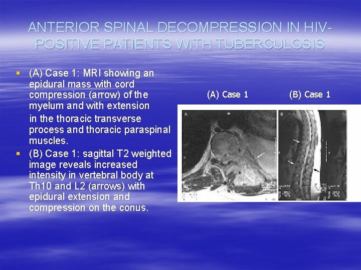 ANTERIOR SPINAL DECOMPRESSION IN HIVPOSITIVE PATIENTS WITH TUBERCULOSIS § (A) Case 1: MRI showing
