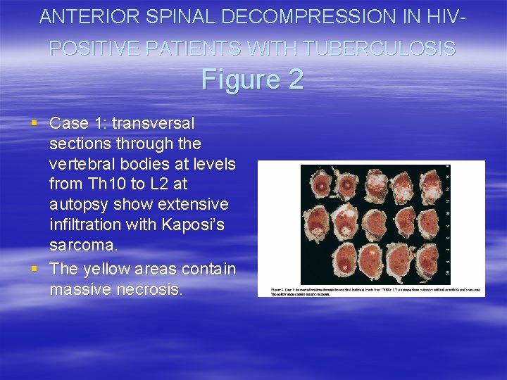 ANTERIOR SPINAL DECOMPRESSION IN HIVPOSITIVE PATIENTS WITH TUBERCULOSIS Figure 2 § Case 1: transversal