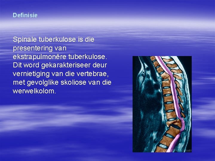 Definisie Spinale tuberkulose is die presentering van ekstrapulmonêre tuberkulose. Dit word gekarakteriseer deur vernietiging