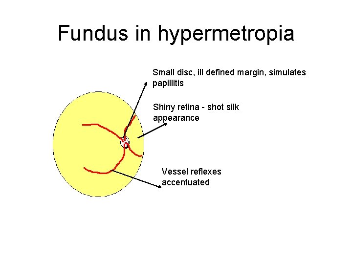 Fundus in hypermetropia Small disc, ill defined margin, simulates papillitis Shiny retina - shot