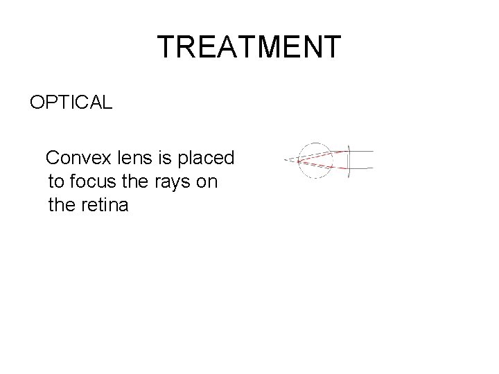 TREATMENT OPTICAL Convex lens is placed to focus the rays on the retina 