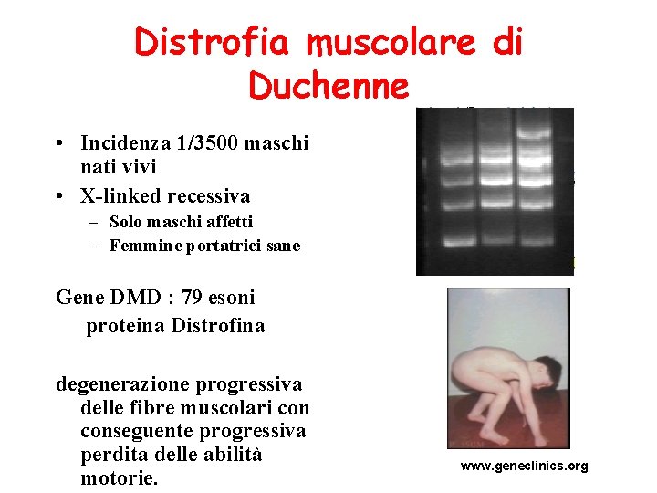 Distrofia muscolare di Duchenne • Incidenza 1/3500 maschi nati vivi • X-linked recessiva –