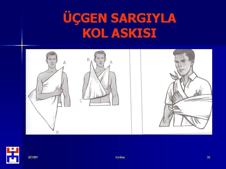 ÜÇGEN SARGIYLA KOL ASKISI BİYEM Kırıklar 38 