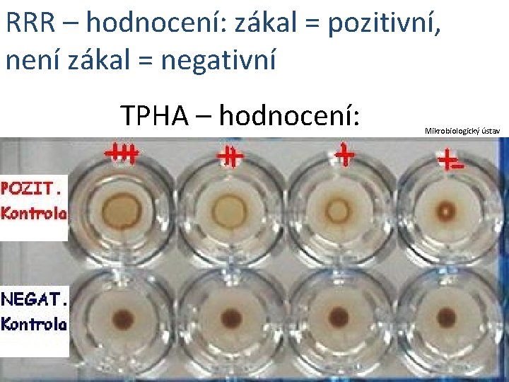 RRR – hodnocení: zákal = pozitivní, není zákal = negativní TPHA – hodnocení: Mikrobiologický