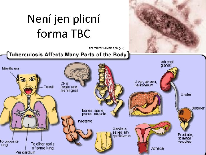 Není jen plicní forma TBC sitemaker. umich. edu (2×) 