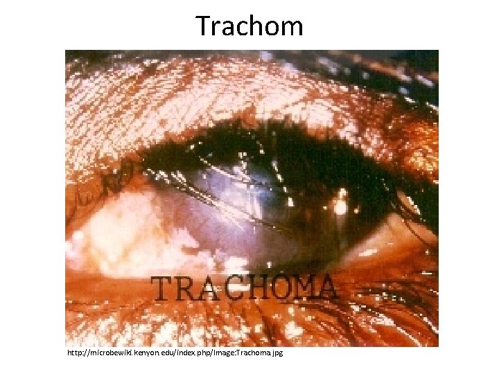 Trachom http: //microbewiki. kenyon. edu/index. php/Image: Trachoma. jpg 