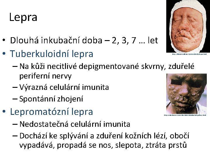 Lepra • Dlouhá inkubační doba – 2, 3, 7 … let • Tuberkuloidní lepra