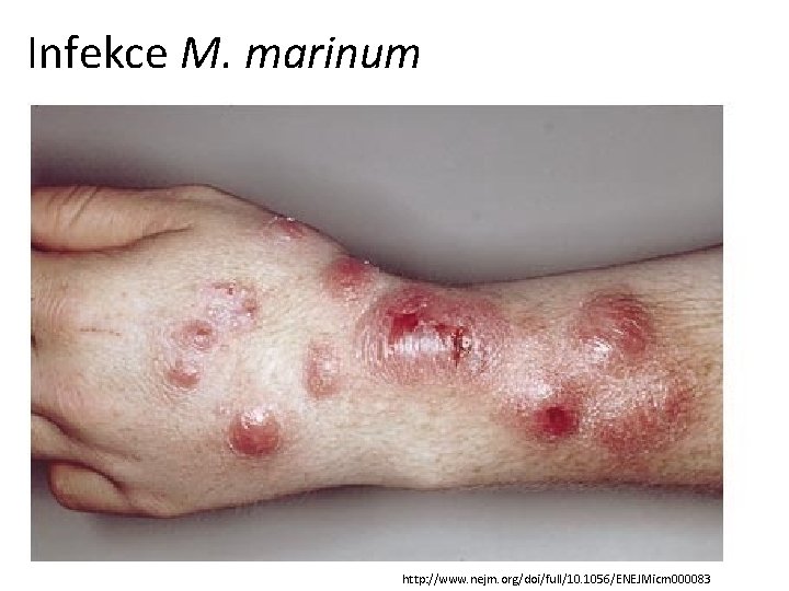 Infekce M. marinum http: //www. nejm. org/doi/full/10. 1056/ENEJMicm 000083 