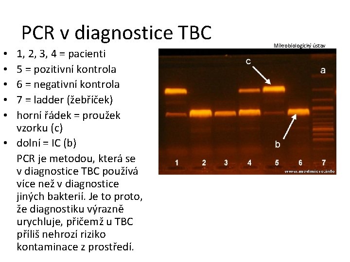 PCR v diagnostice TBC 1, 2, 3, 4 = pacienti 5 = pozitivní kontrola