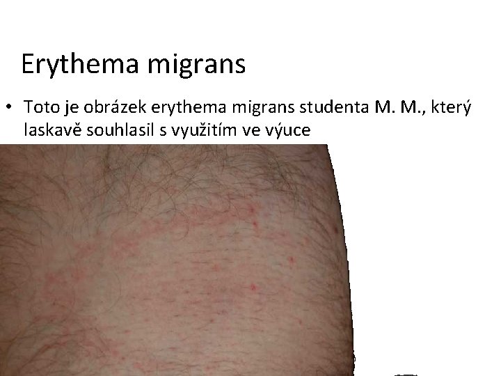 Erythema migrans • Toto je obrázek erythema migrans studenta M. M. , který laskavě