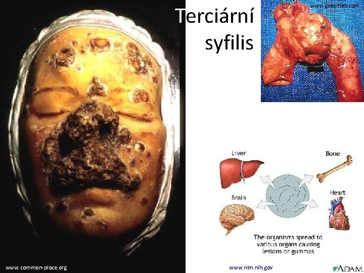 Terciární syfilis www. common-place. org www. nlm. nih. gov www. geocities. com 