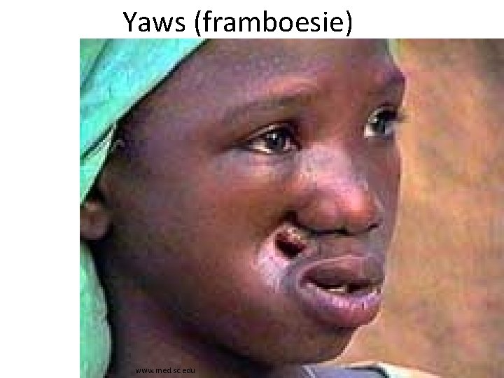 Yaws (framboesie) www. med. sc. edu 