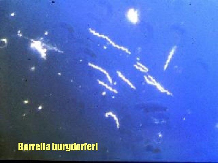 Borrelia burgdorferi 