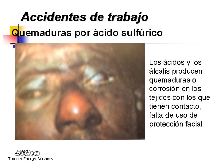 Accidentes de trabajo Quemaduras por ácido sulfúrico Los ácidos y los álcalis producen quemaduras