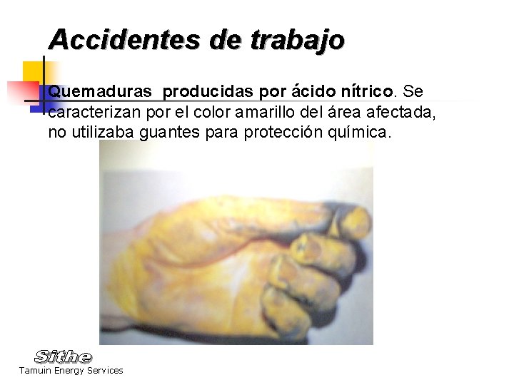 Accidentes de trabajo Quemaduras producidas por ácido nítrico. Se caracterizan por el color amarillo