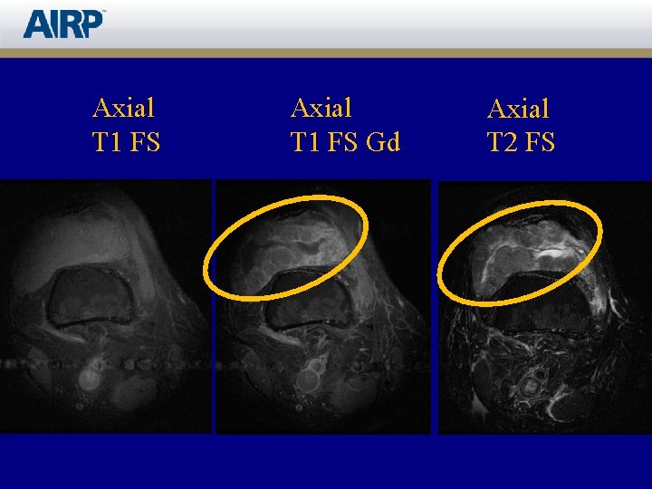 Axial T 1 FS Gd Axial T 2 FS 