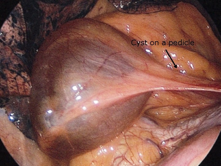 Cyst on a pedicle 