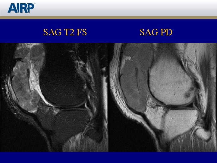 SAG T 2 FS SAG PD 