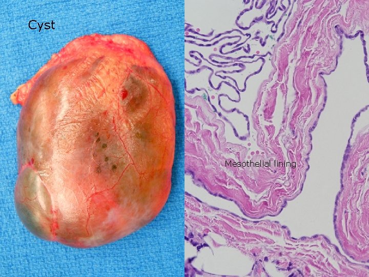 Cyst Mesothelial lining 